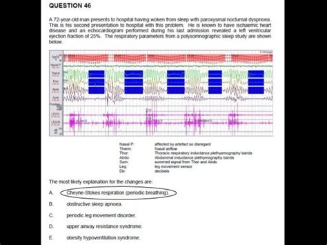 interpreting sleep study results|Iba pa.